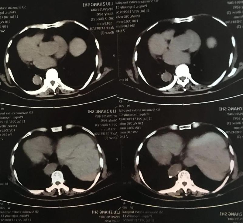 Medical Hospital CT Blue Thermal Film for Agfa Printer
