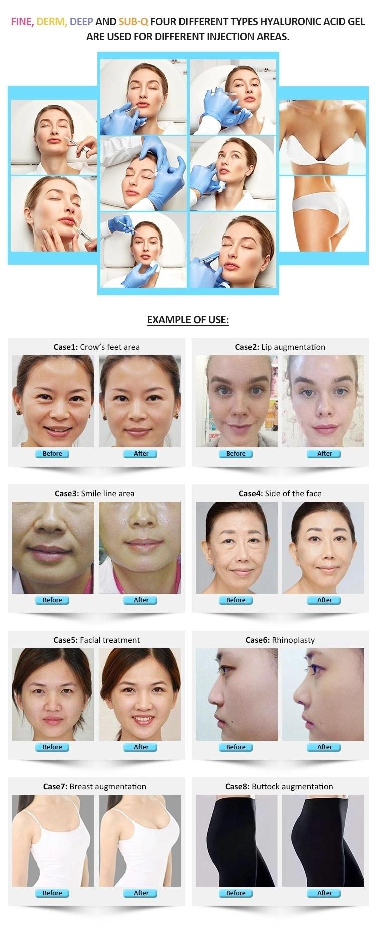 Hyaluronic Acid Facial Filler to Keep Skin Younger