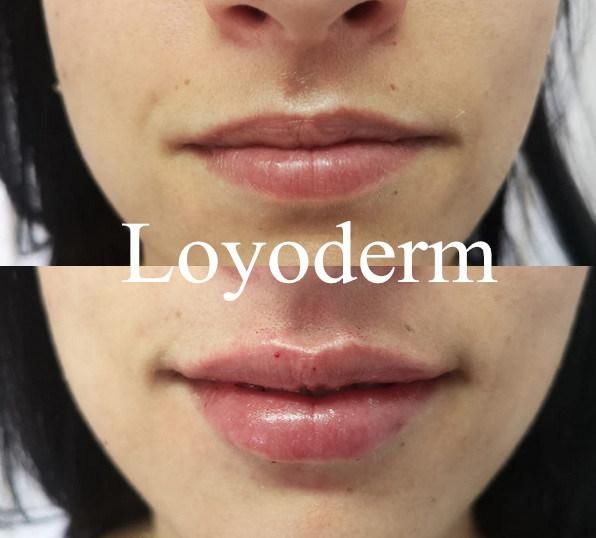 Loyoderm Lip Inejctions Dermal Fillers That Have Hyaluronic Acid