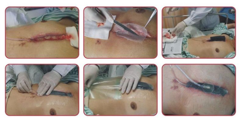 Npwt Dressing Kit for Negative Pressure Wound Therapy