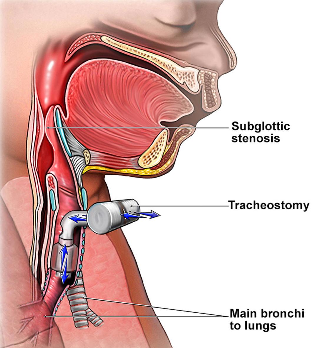 Medical Supplies Disposable PVC Tracheostomy Tube Endotracheal Tube Tracheal Tube