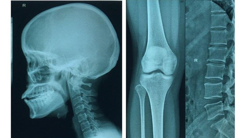 Medical X Ray Film Cr Dr CT Scanner in Radiology Equipment