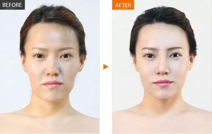 Ha Injectable Facial Dermal Fillers for Lip Augmentation with Ce