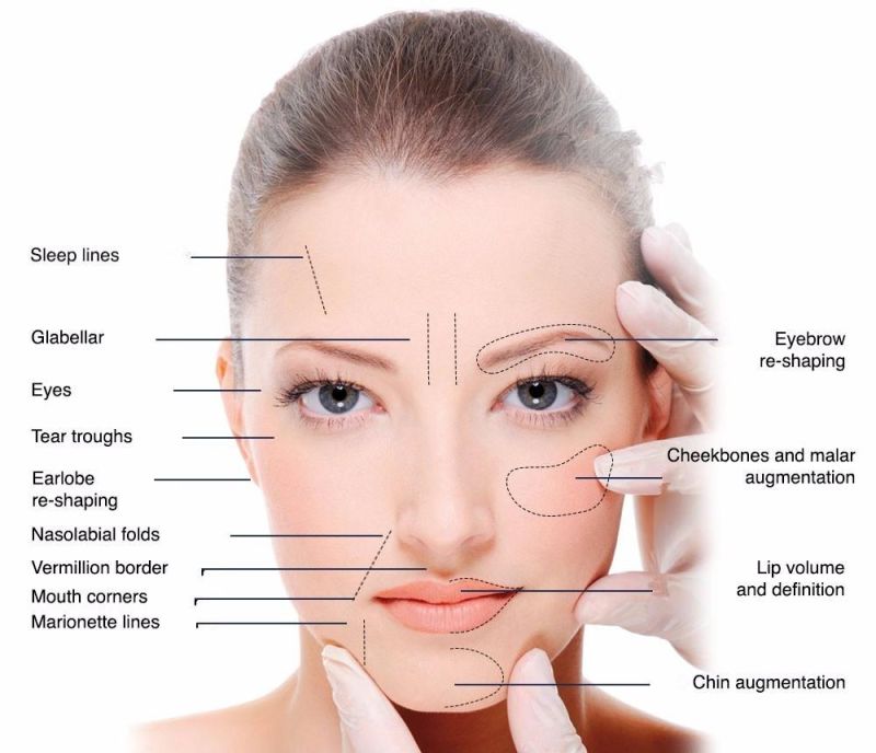 Cross Linked Injectable Facial Hyaluronic Acid Dermal Filler for Face