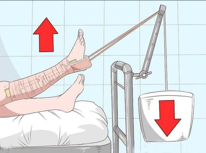 Mdr CE Approved High Reputation Sterile Single Use Adult Skin Traction Kit Bandage