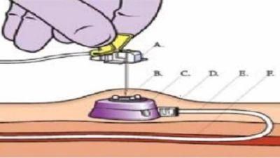 Long-Term Implantation Transfusion Device with Better Quality