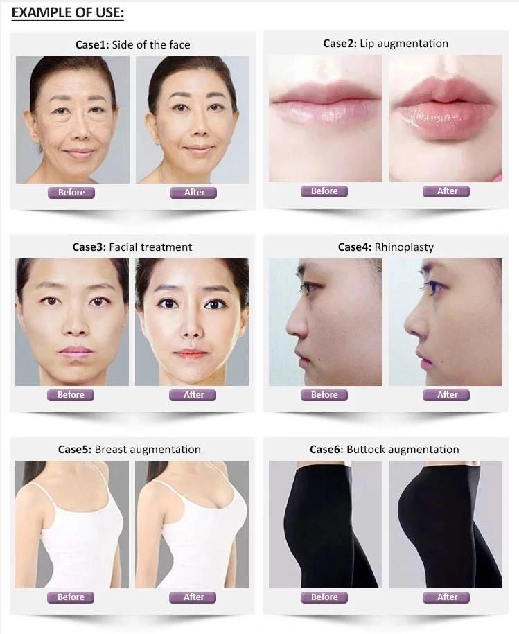 Best Selling Elravie Dermal Fillers Anti-Wrinkle Injection Cross-Linked Korea Hyaluronic Acid Buy Facial Dermal Fillers