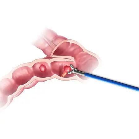 Endoscope Surgery Od 1.8mm Length 1600mm 1800mm Disposable Biopsy Forceps for Ultrafine Gastroscope