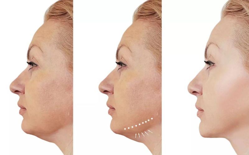 Fat Dissolving Solution Injection Double Chin Burning Fat Serum