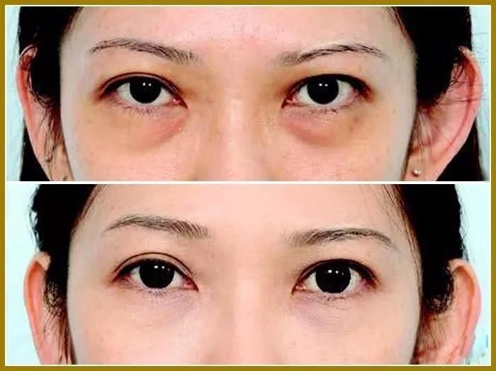Anti Wrinkle Facial Dermal Fillers for Removing Eyes Circle Tear Grooves