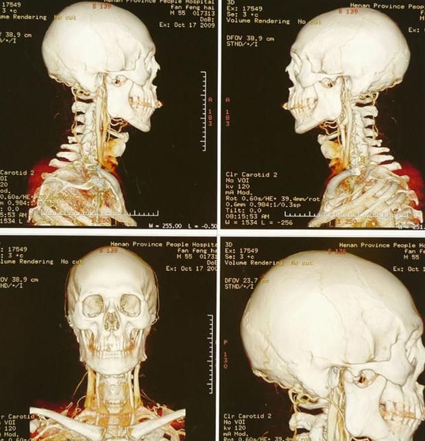 13*17 Inch and A3 Printing Medical X-ray Film Inkjet Film
