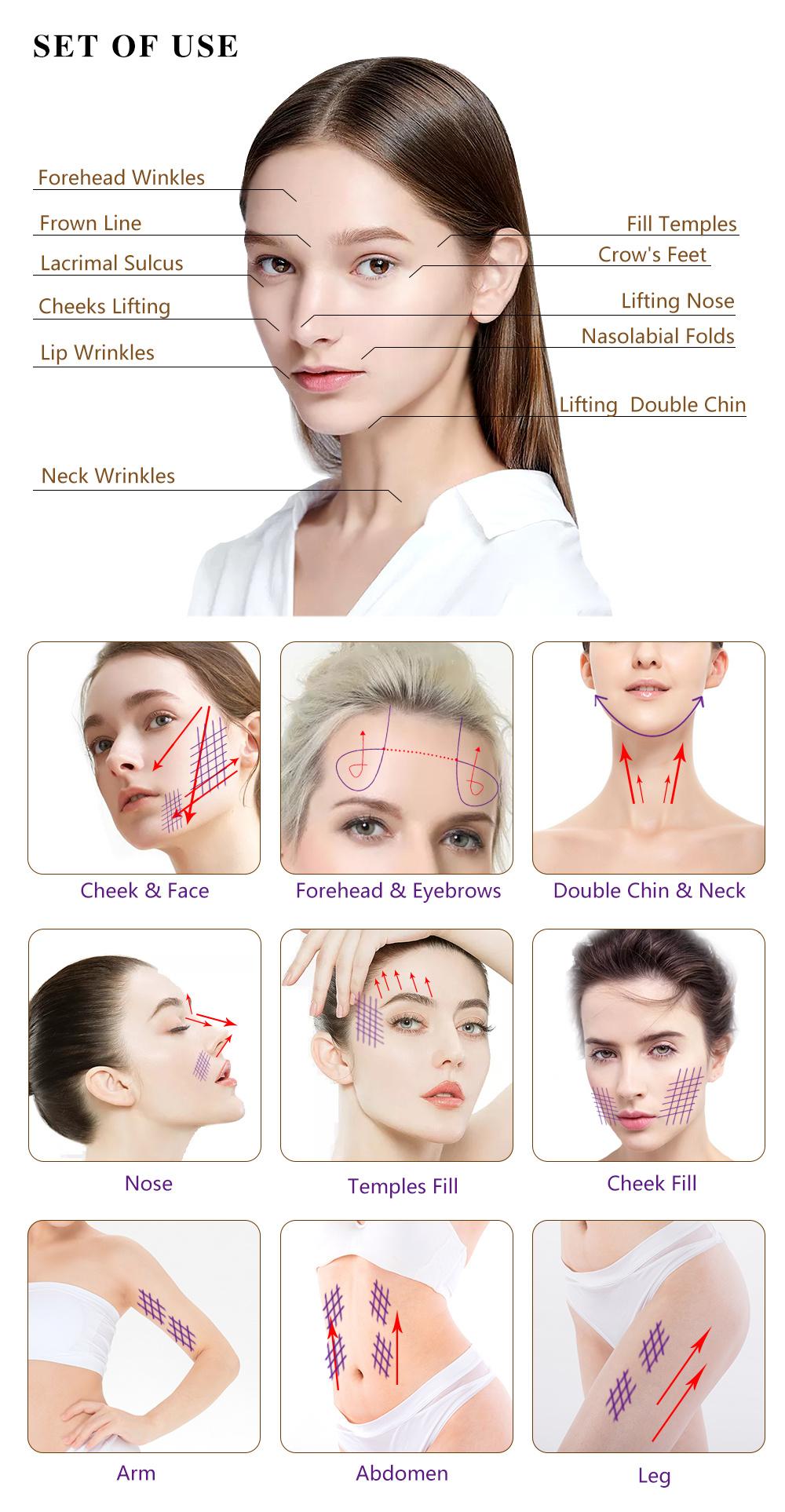 Cosmetic Mono Pdo Threads for Full Face Lifting Injection Near Me