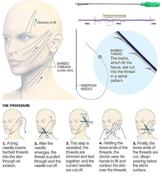 Pdo Threads 29*380mm for Double Chin Under Skin Tightening Treatment Procedure