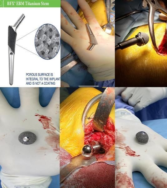 Customized Porous Medical Implant for Surgical Treatment