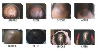 Best Way to Increase Grow Natural Black Hair Loss Fall Promote Fast Hairline Growth Treatment Women