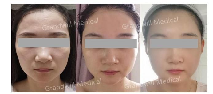 Private Logo Pcl Hyaluronic Acid Injection Skin Booster Collagen Stimulator for Anti Ageing Anti Wrinkle