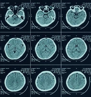 Radiology Medical Dry Film/Dry Thermal Film 35X43 Cm