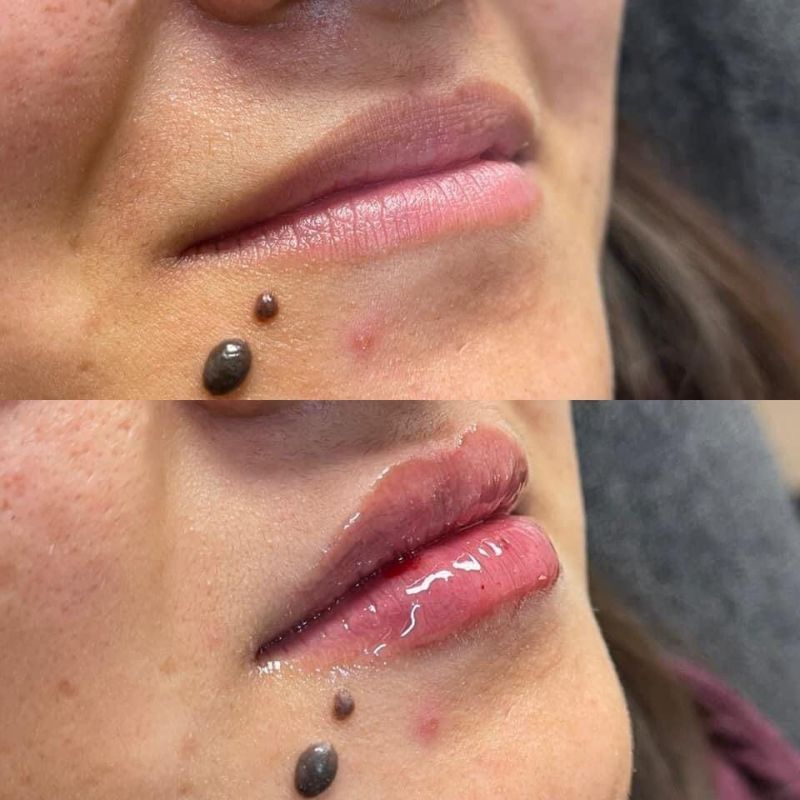 Ha Sodium Hyaluronate Injections with CE Certification
