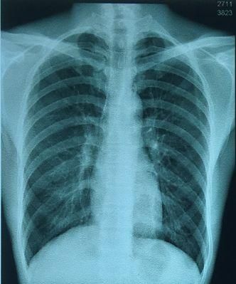 Digital Chest X-ray Films Inkjet Blue Image