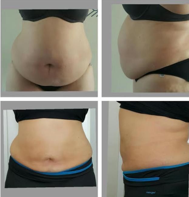 Fat Dissolving Solution Injection Double Chin Burning Fat Serum