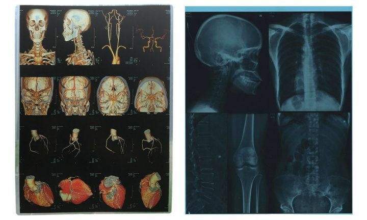 8*10 and 10*12 Inkjet Printing Film for Medical Purpose