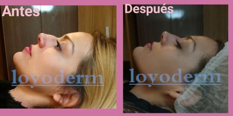 Loyoderm Lip Inejctions Dermal Fillers That Have Hyaluronic Acid