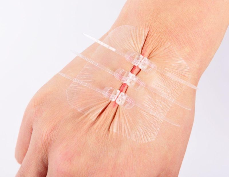 Medical Skin Adhesive Wound Closure Device