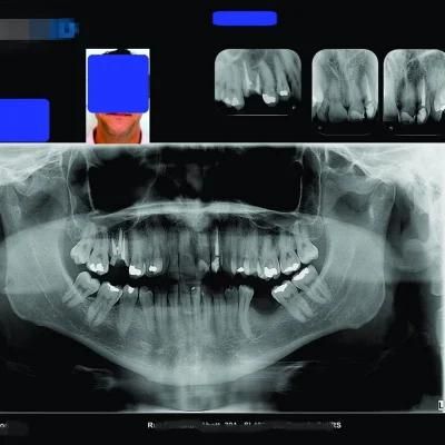 Hot Sale 8X10inch Dental Materials Medical Blue Film