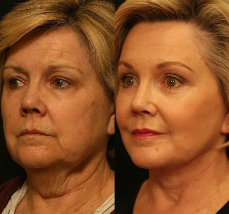 CE 1ml Improve Facial Wrinkles Hyaluronic Acid Dermal Filler for Nose Augmentation