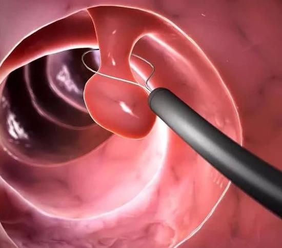 Endoscopy Accessories Disposable Rotatable Polypectomy Snare for Polyp Retrieval