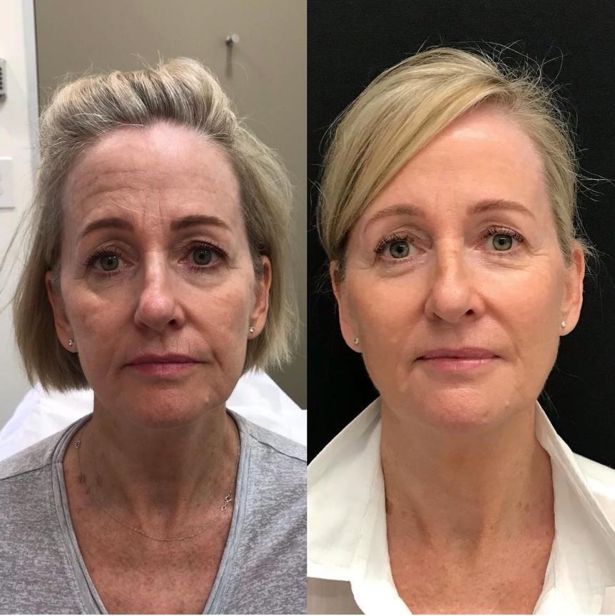 CE 1ml Improve Facial Wrinkles Hyaluronic Acid Dermal Filler for Nose Augmentation