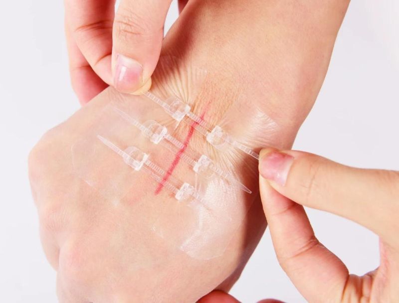 CE Approved Medical Adhesive Wound Closure Device