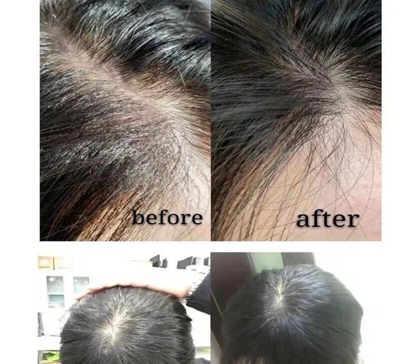 Innoaesthetics Hair Loss Control for Man to Growth Hair Innoaesthetics Hair Loss Control