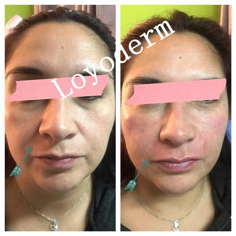 Loyoderm Lip Inejctions Dermal Fillers That Have Hyaluronic Acid