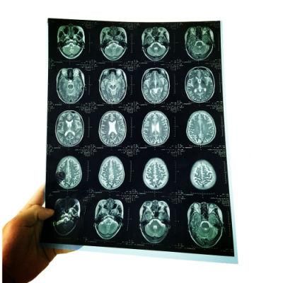 Blue X Ray Film Medical X-ray Film Inkjet Printer 14*17inch Radiology
