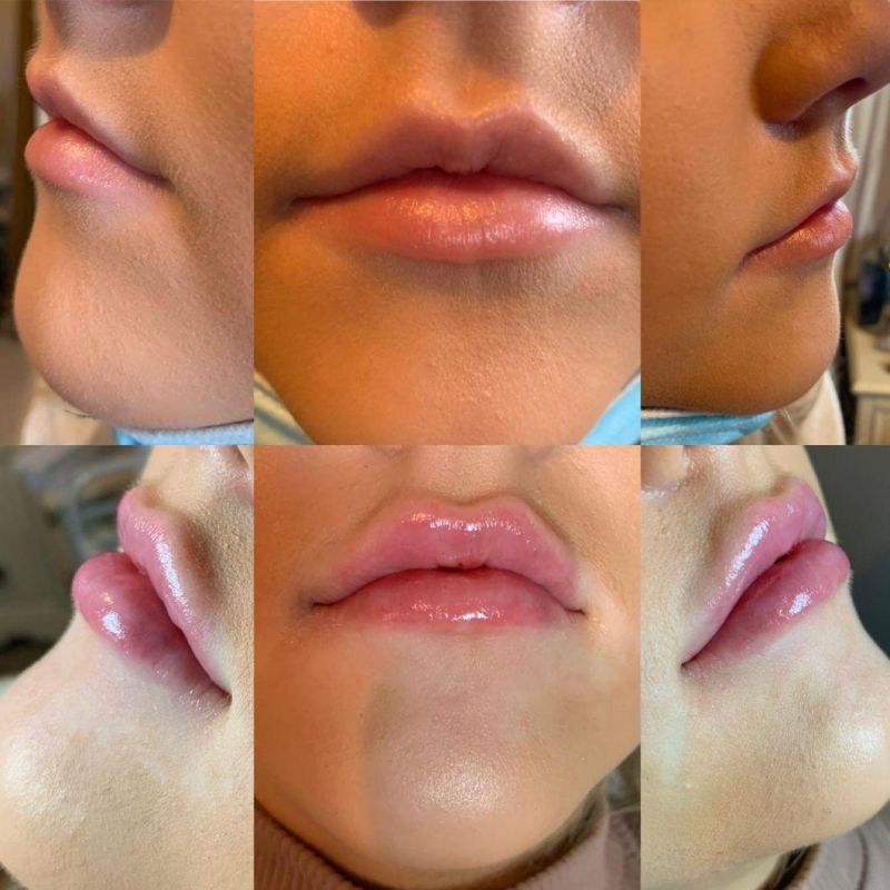 Ultra 3 and Ultra 4 Juvaderm Dermal Filler