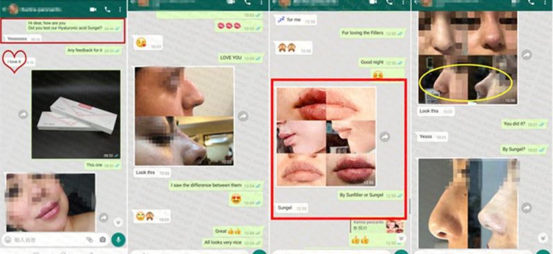 CE Sungel Cosmetic Lip Injection Hyaluronic Acid Dermal Filler for Plastic Surgery