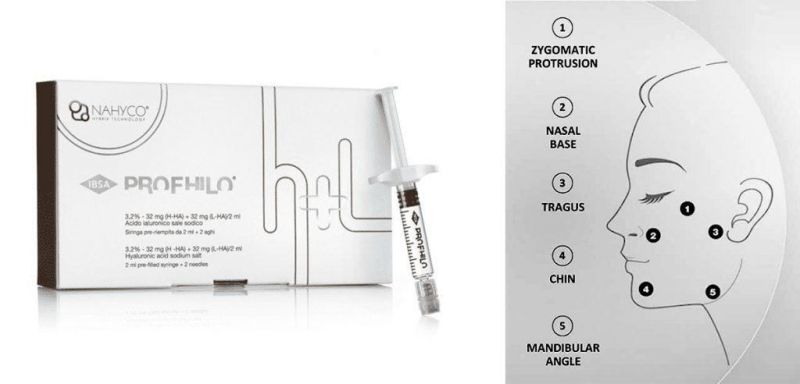 Profhilo Injection Points Forehead Skin Booster