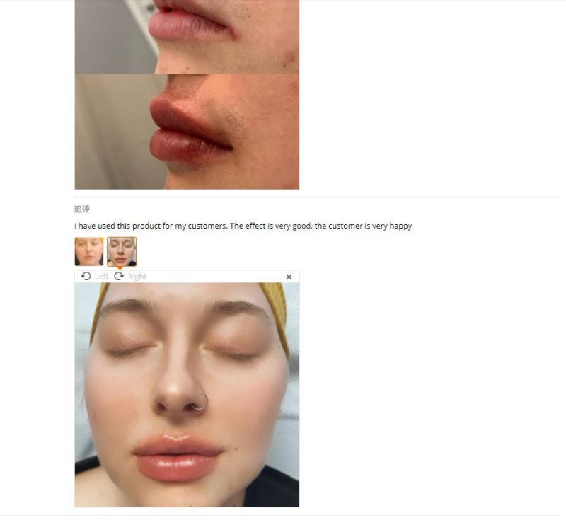 Hyaluronic Acid Korea Dermal Facial Filler Revolax Deep Filler for Lip Use