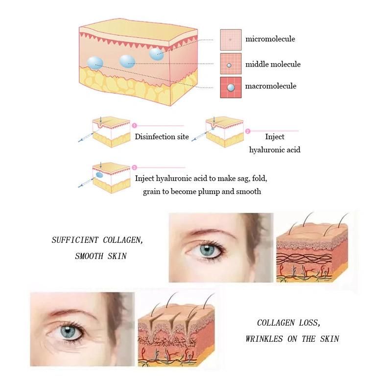 10ml Hyaluronic Acid Hydrogel Big Buttock and Breast Enlargement and Hip Augmentation Filler Injection to Increase Breast Size