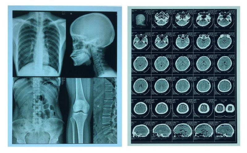 A4 and 11*14 X-ray Medical Film in Image Output Digital Printing