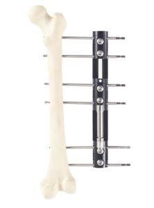 Orthopedic External Fixation Series Bone Lengthening Fixator