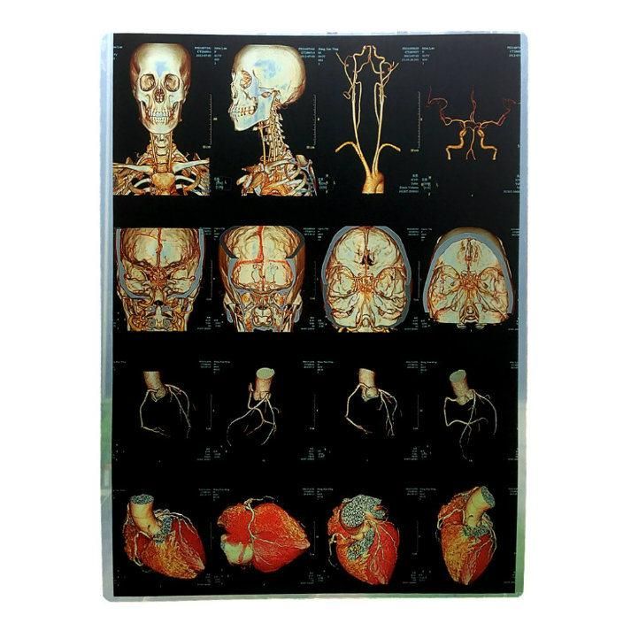 Inkjet X Ray Medical Dry Blue Imaging Films