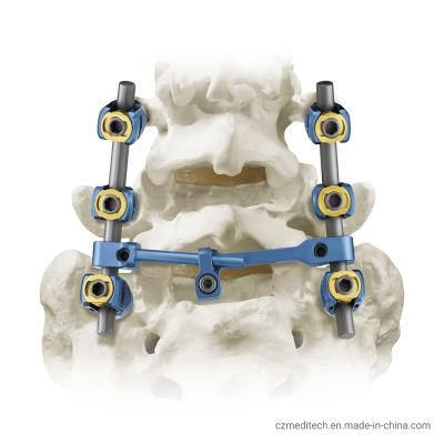 Competitive Price Orthopedic Surgical Implants Titanium Spinal Pedicle Screw