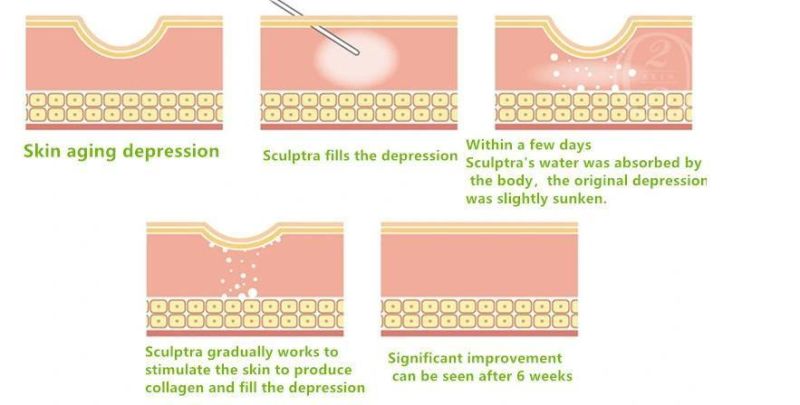 Facial Injection Surgery Plla Polylactic 3D Poly-L-Lactic Acid Sculptr Wrinkles Remove Lifting Dermal Filler