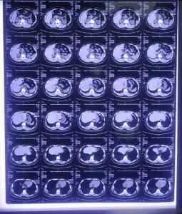 Medical Printing Radiology Universal Dry Film 35*43cm Medical Blue Thermal Film/X-ray Printer Hospital Film