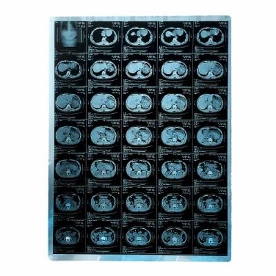 Pet Blue Medical Radiology Inkjet X Ray Film for Canon Epson Printing X-ray CT Dr