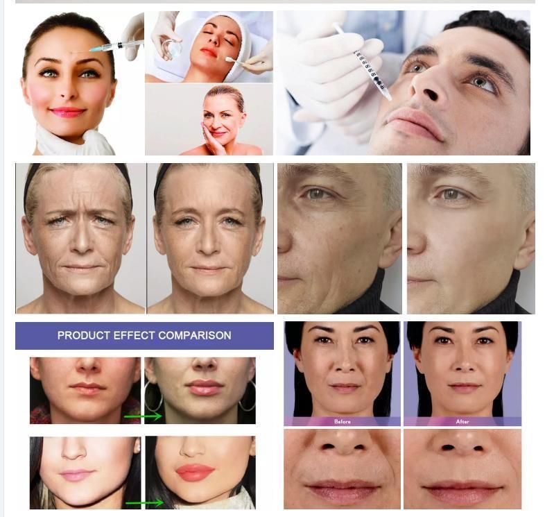 Hot Sale Anti Wrinkle Hyaluronic Acid Dermal Filler Facial Plastic Filler