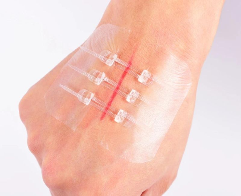 CE Approved Medical Adhesive Wound Closure Device