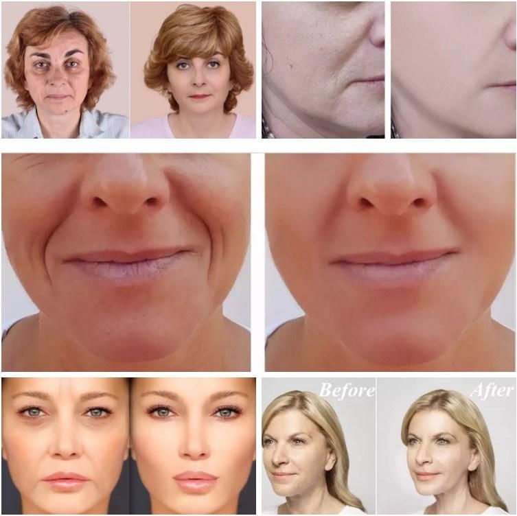 2020 Fine Derm Deep Ultra Deep 2ml Injectable Hyaluronic Acid Dermal Filler Gel for Forehead/Nose